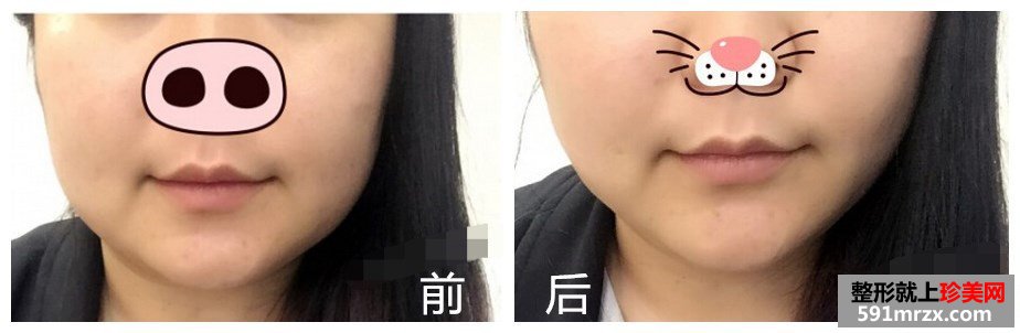 初次打瘦脸针，效果还是很满意的！