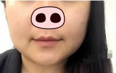 瘦脸针效果好不好？