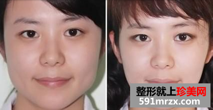 botox瘦脸针效果如何 下面两个案例告诉你