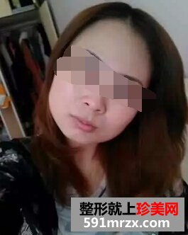 注射botox瘦脸针过后 脸型得到了很好改善