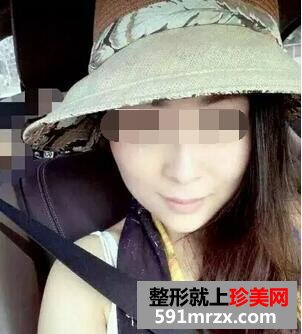 注射botox瘦脸针过后 脸型得到了很好改善