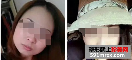 注射botox瘦脸针过后 脸型得到了很好改善