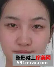卧蚕眼填充+注射瘦脸针 微整形让我获得美丽与自信