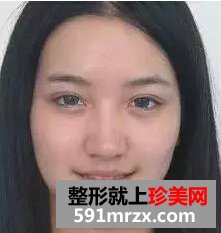 卧蚕眼填充+注射瘦脸针 微整形让我获得美丽与自信