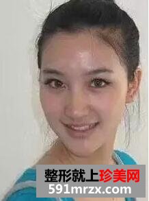 卧蚕眼填充+注射瘦脸针 微整形让我获得美丽与自信