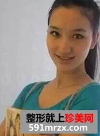 填充卧蚕+注射瘦脸针案例