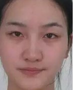 卧蚕眼填充+注射瘦脸针让我获得美丽与自信