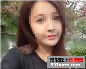 打瘦脸针前后效果图 瘦脸效果真的不错哦