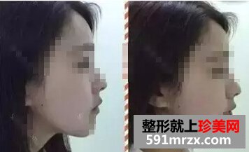 打瘦脸针前后效果图 瘦脸效果真的不错哦