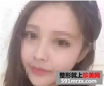 打瘦脸针前后效果图 瘦脸效果真的不错哦