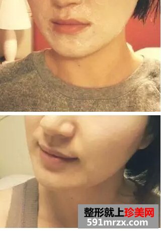 打瘦脸针3个月了 朋友们都以为我只是瘦了