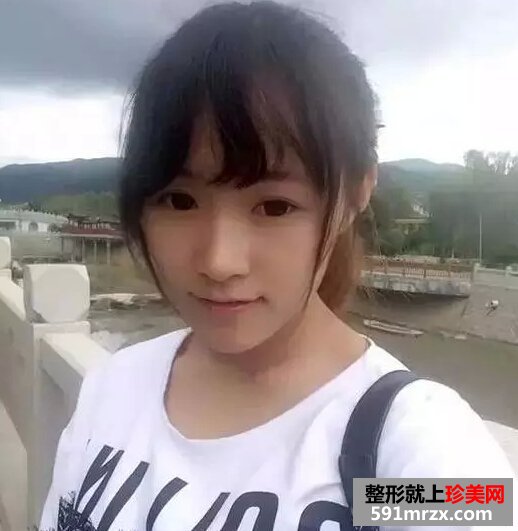 打了botox瘦脸针 我也拥有巴掌脸了