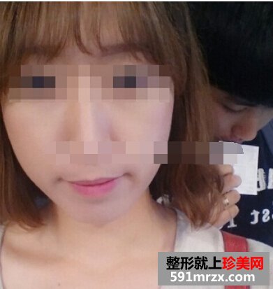 注射瘦脸针一个月了 男盆友说我变漂亮了