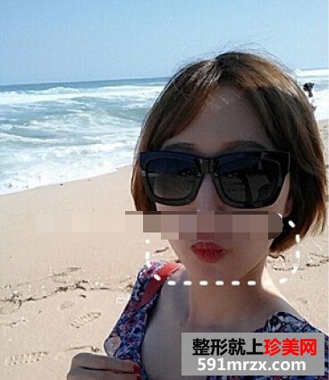 注射瘦脸针一个月了 男盆友说我变漂亮了