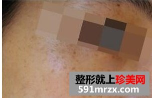 做白瓷娃娃一个疗程了 皮肤有光泽了