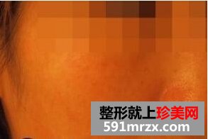 做白瓷娃娃一个疗程了 皮肤有光泽了
