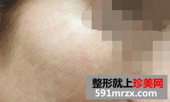做白瓷娃娃一个疗程了 皮肤有光泽了