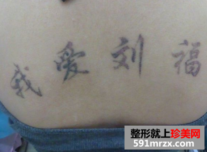做了三次激光洗纹身 终于把背上洗干净了