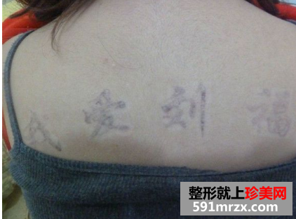 做了三次激光洗纹身 终于把背上洗干净了