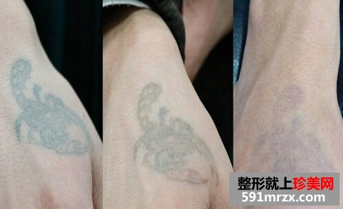 做了几次激光洗纹身 手上腿上都干净了