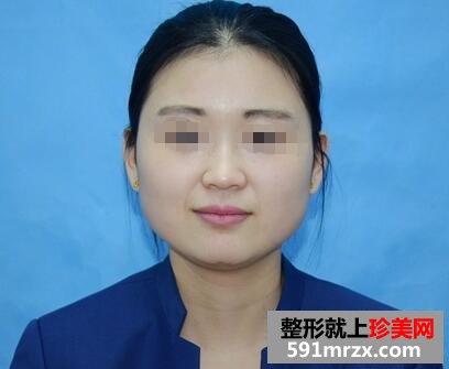 注射玻尿酸隆鼻+注射瘦脸针 一周后效果立见