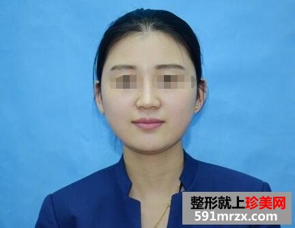 注射玻尿酸隆鼻+注射瘦脸针 一周后效果立见