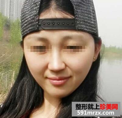 注射玻尿酸隆鼻+注射瘦脸针 一周后效果立见