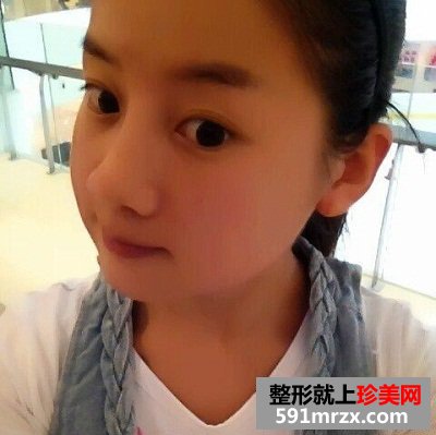 婴儿肥做了面部吸脂 面部吸脂效果图奉上