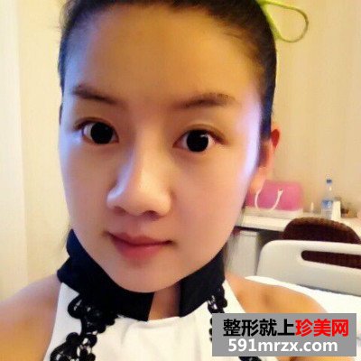 婴儿肥做了面部吸脂 面部吸脂效果图奉上