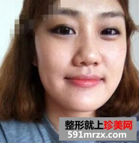 下颌角整形案例 同学都说我像张馨予