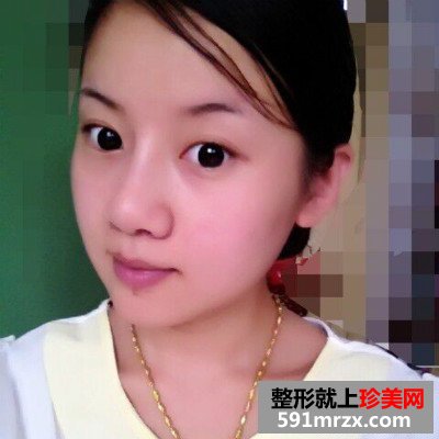 婴儿肥做了面部吸脂 面部吸脂效果图奉上