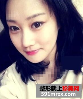 下颌角整形案例 同学都说我像张馨予