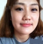 下颌角整形,同学都说我像张馨予