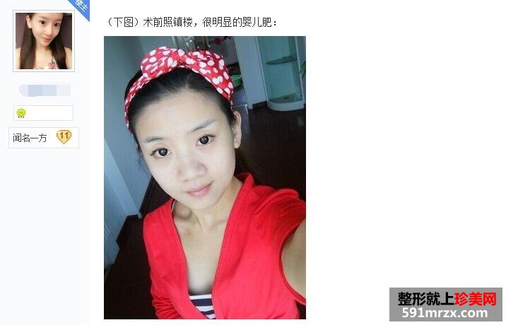 贴吧分享：面部吸脂减肥过程 婴儿肥看过来