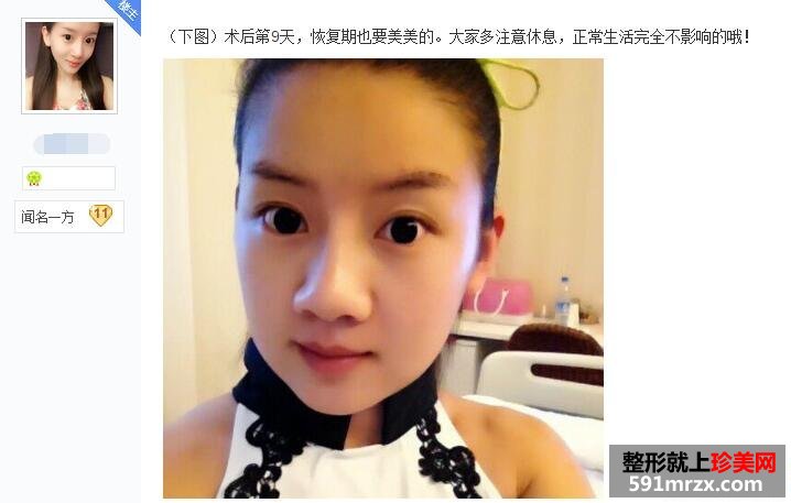 贴吧分享：面部吸脂减肥过程 婴儿肥看过来