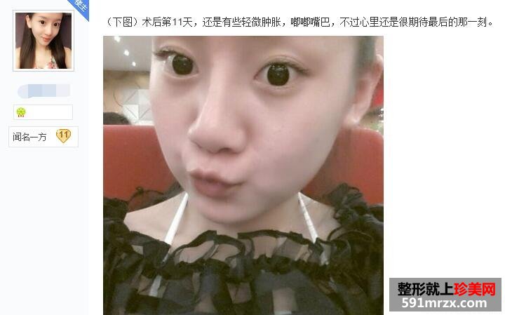 贴吧分享：面部吸脂减肥过程 婴儿肥看过来