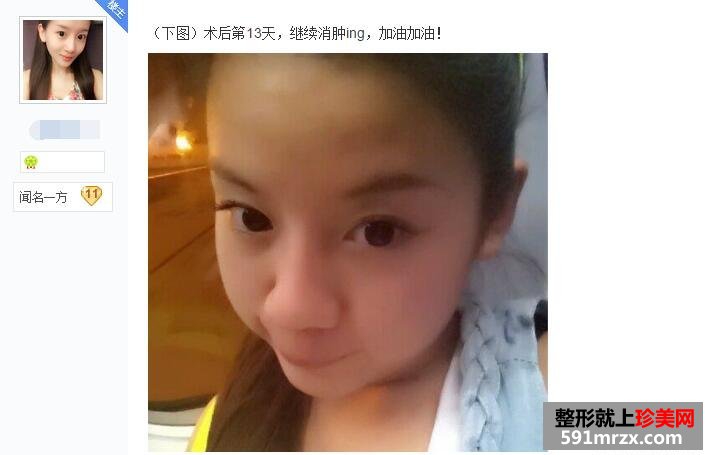 贴吧分享：面部吸脂减肥过程 婴儿肥看过来