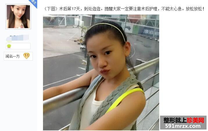 贴吧分享：面部吸脂减肥过程 婴儿肥看过来
