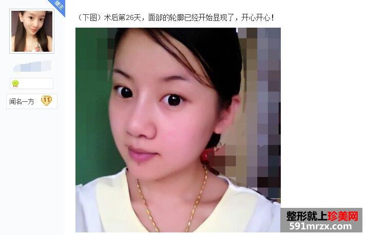 贴吧分享：面部吸脂减肥过程 婴儿肥看过来