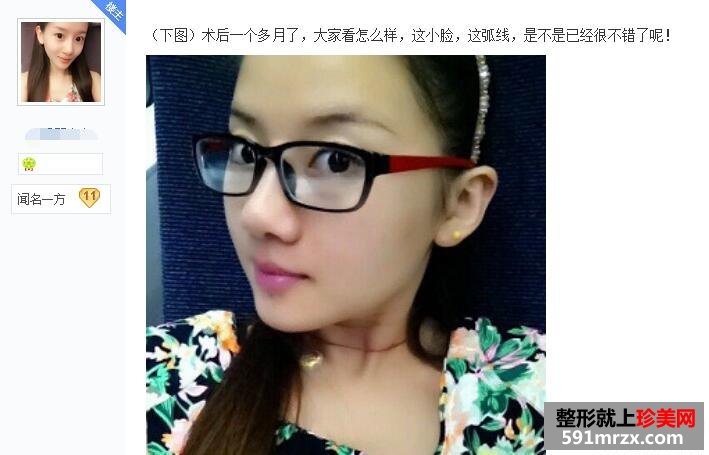 贴吧分享：面部吸脂减肥过程 婴儿肥看过来