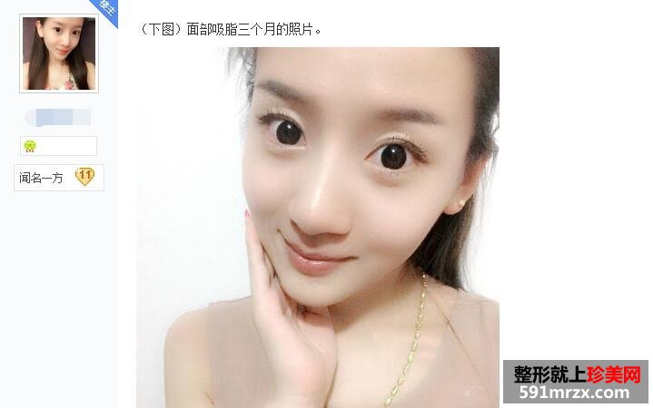贴吧分享：面部吸脂减肥过程 婴儿肥看过来