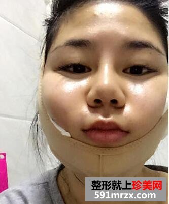 做了瘦脸吸脂术 效果真的很明显