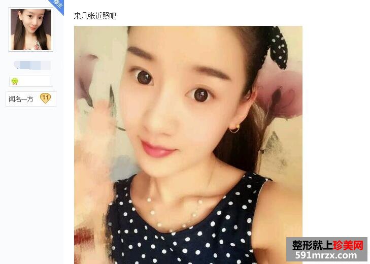 贴吧分享：面部吸脂减肥过程 婴儿肥看过来
