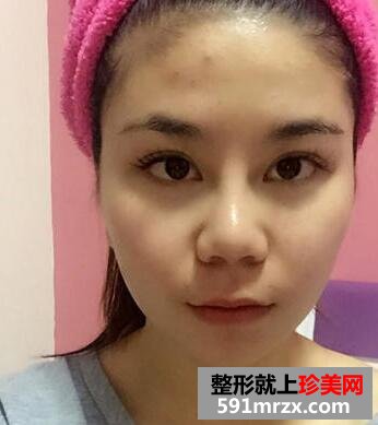 做了瘦脸吸脂术 效果真的很明显