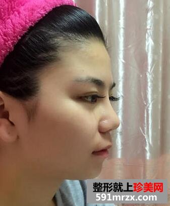 做了瘦脸吸脂术 效果真的很明显