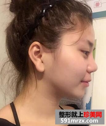 做了瘦脸吸脂术 效果真的很明显