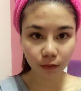 做了瘦脸吸脂术，效果很明显哦！