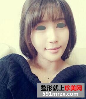 下颌角整形术全过程 花的上万值吗