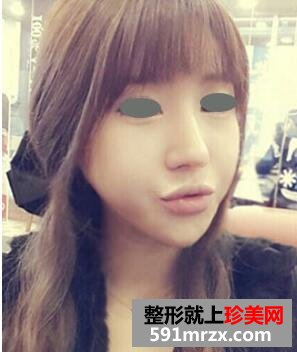下颌角整形术全过程 花的上万值吗