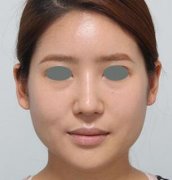 下颌角整形术全过程，花的上万值吗？